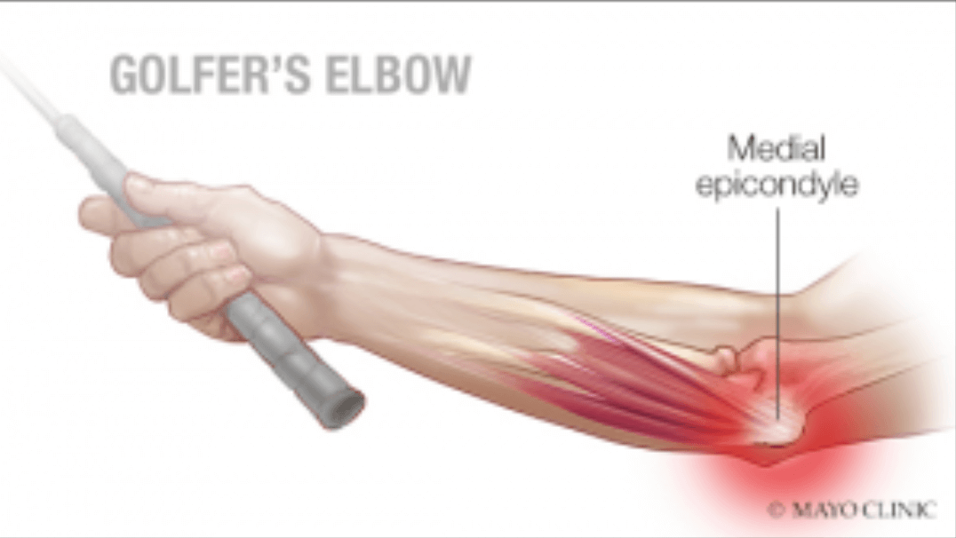 Golfer's Elbow